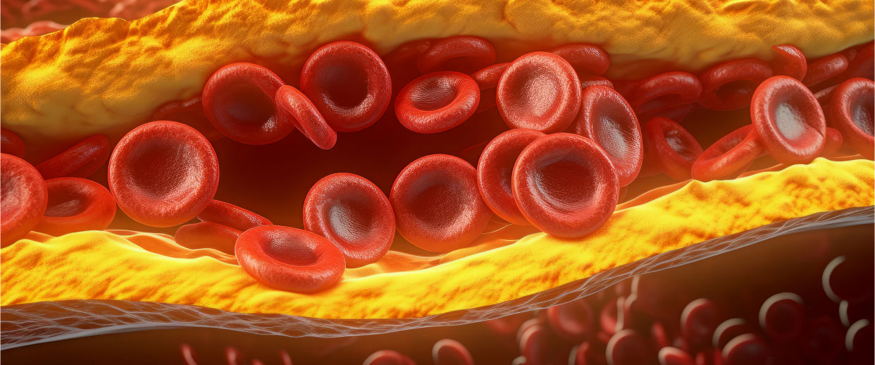 Colesterol LDL: o vilão silencioso que você precisa conhecer